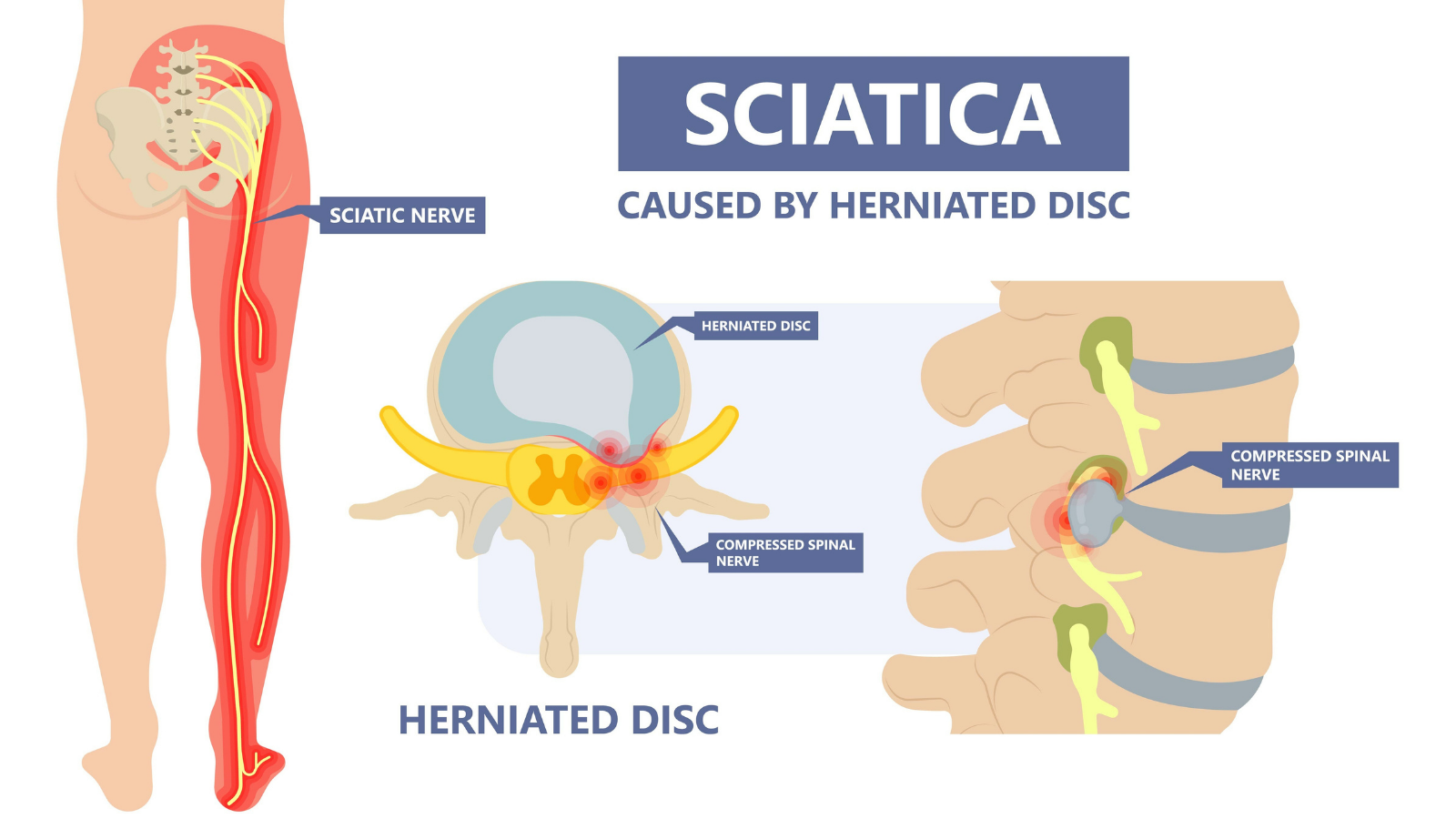  Image showing the Sciatic Nerve and one of the causes of the condition Sciatica