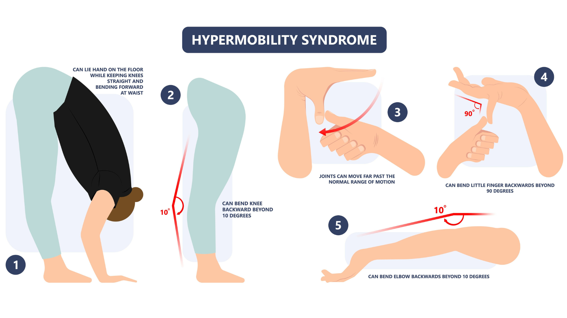 Image depicts physical characteristics of Joint Hypermobility.