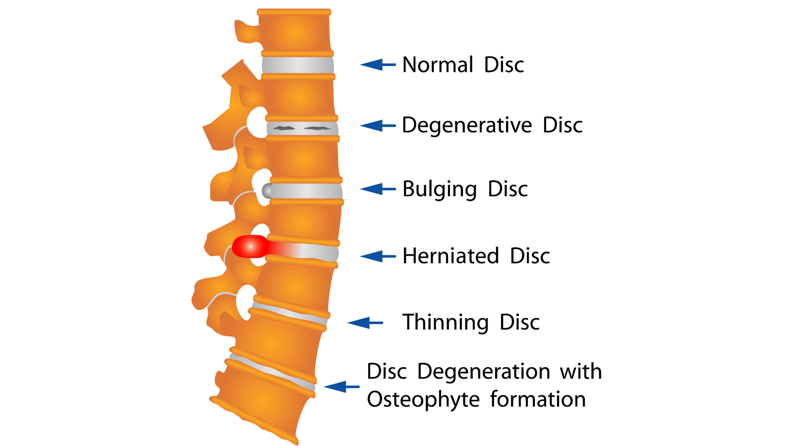 Image depicting different kinds of disc problems.