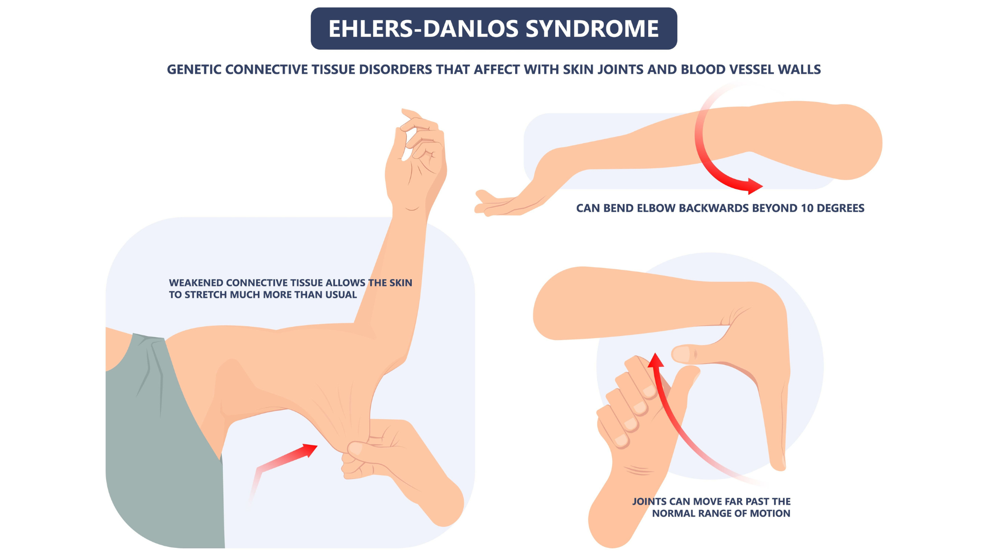 Image depicts physical symptoms and characteristics of Ehlers-Danlos Syndrome