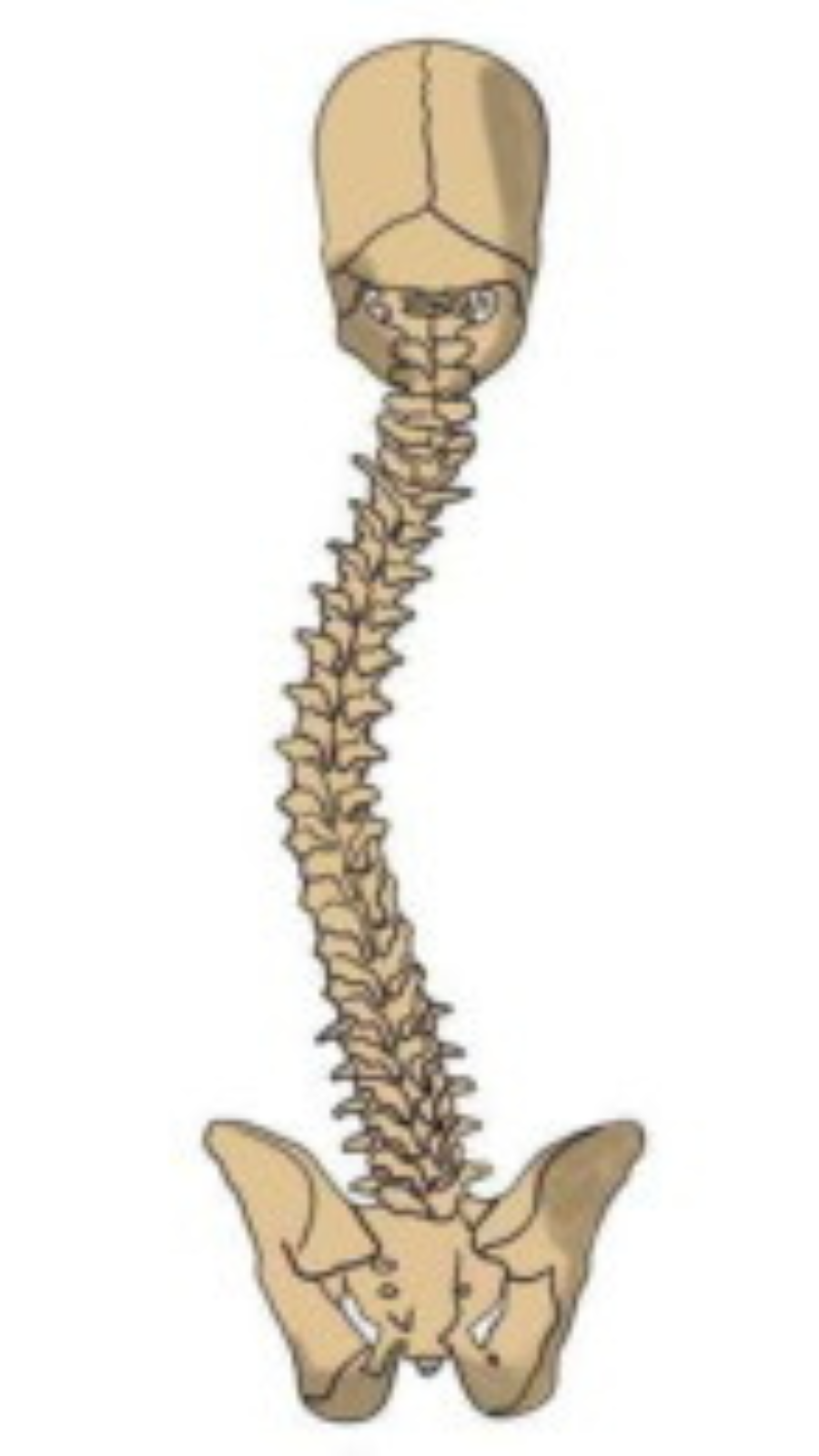 Image depicts a spine with Scoliosis.