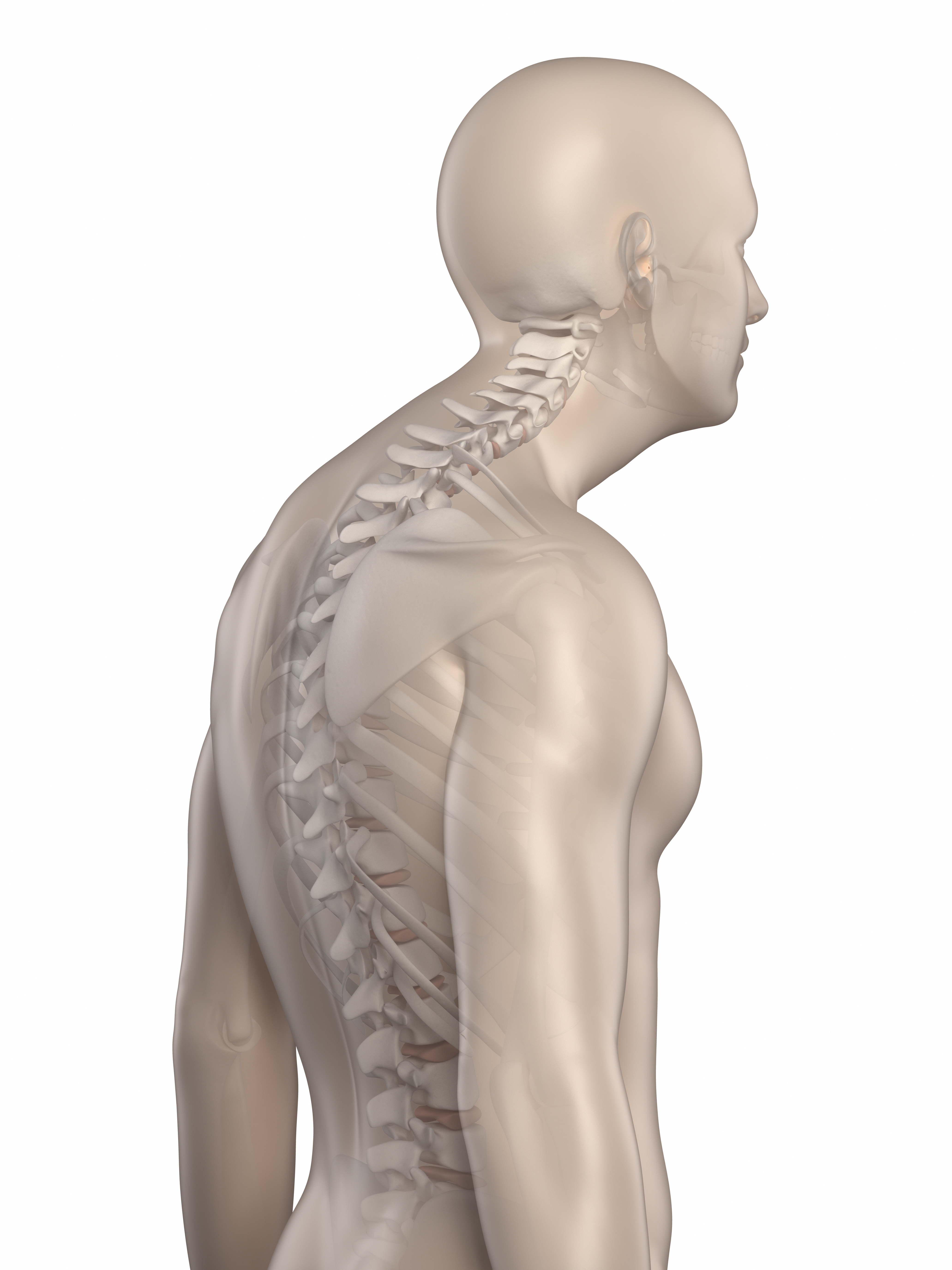 hyperkyphosis illustration