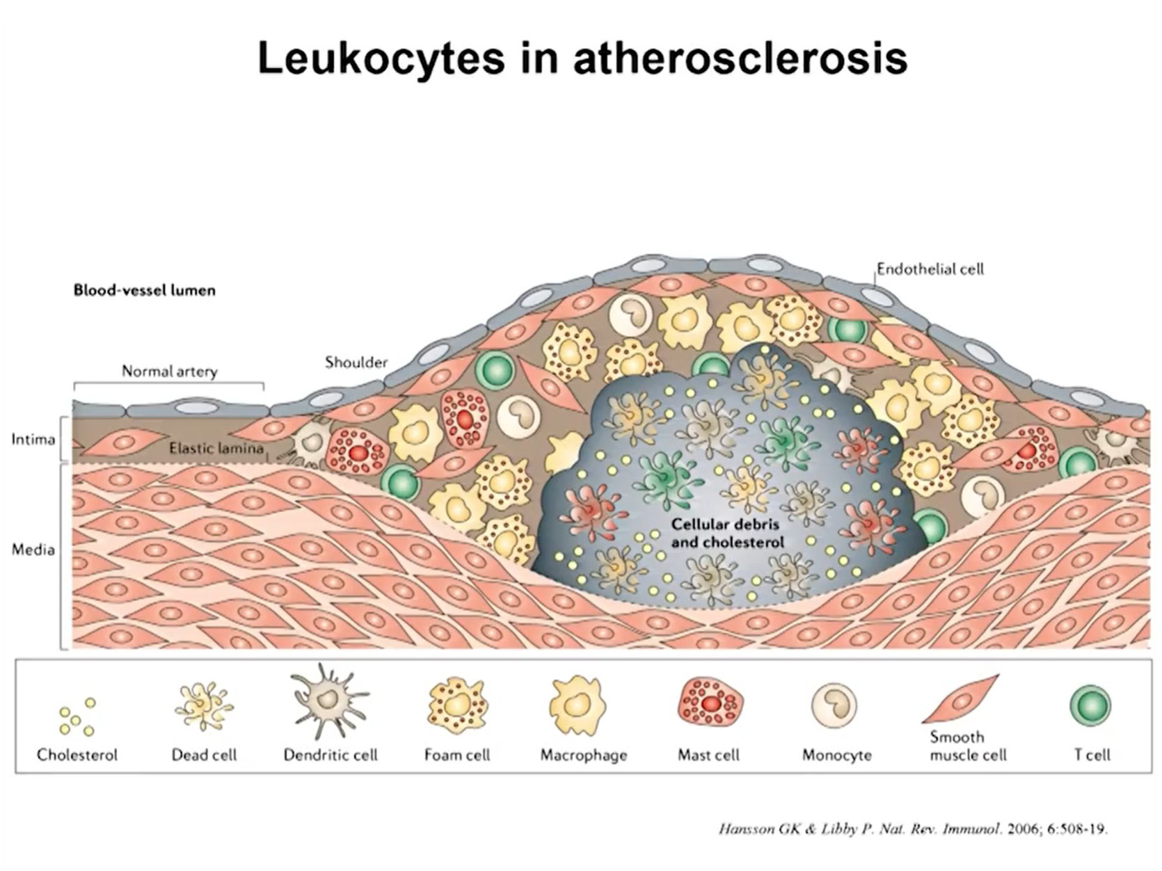 altherosclerosis, waste,  plaque build up, leukocytes ( immune system cells)