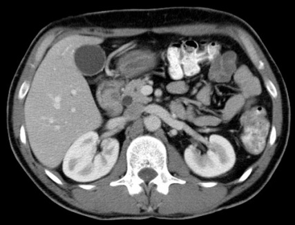 Kidneys shown in CT scan