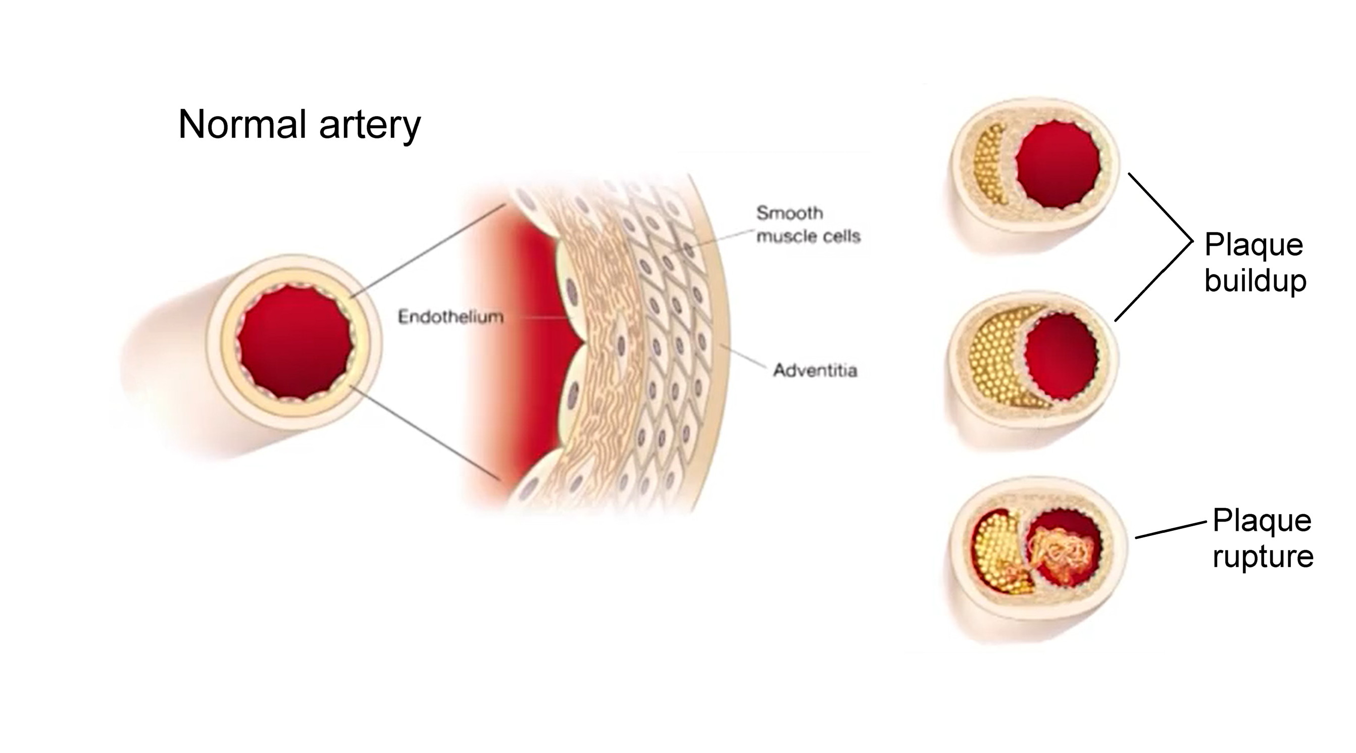 Normal artery, arteries with plaque, health implications of plaque on arteries